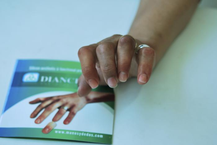 protesis de dedos